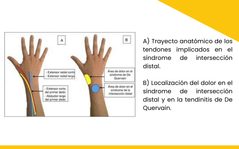 Sindrome interseccion distal ecografia tempo formacion 2.png